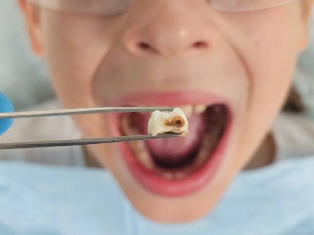Best Emergency Wisdom Teeth Removal in Taylors Falls, MN